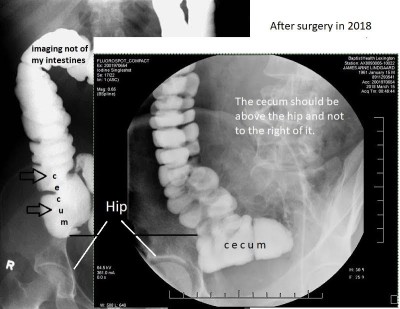 Cecum Comparison.jpg